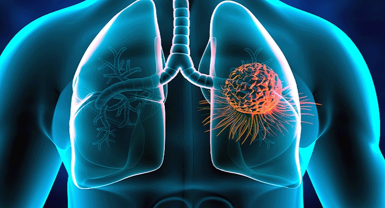 Akciğer Kanseri Aşısı Yolda